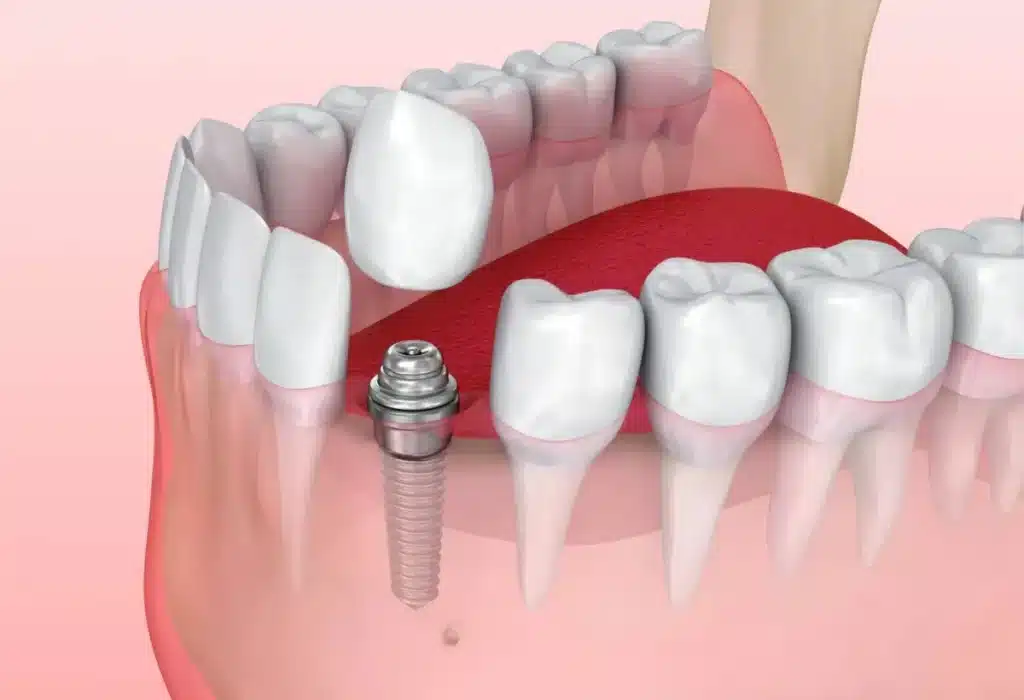 Can You Get All-on-4 Dental Implants With Bone Loss 7 Can You Get All-on-4 Dental Implants With Bone Loss